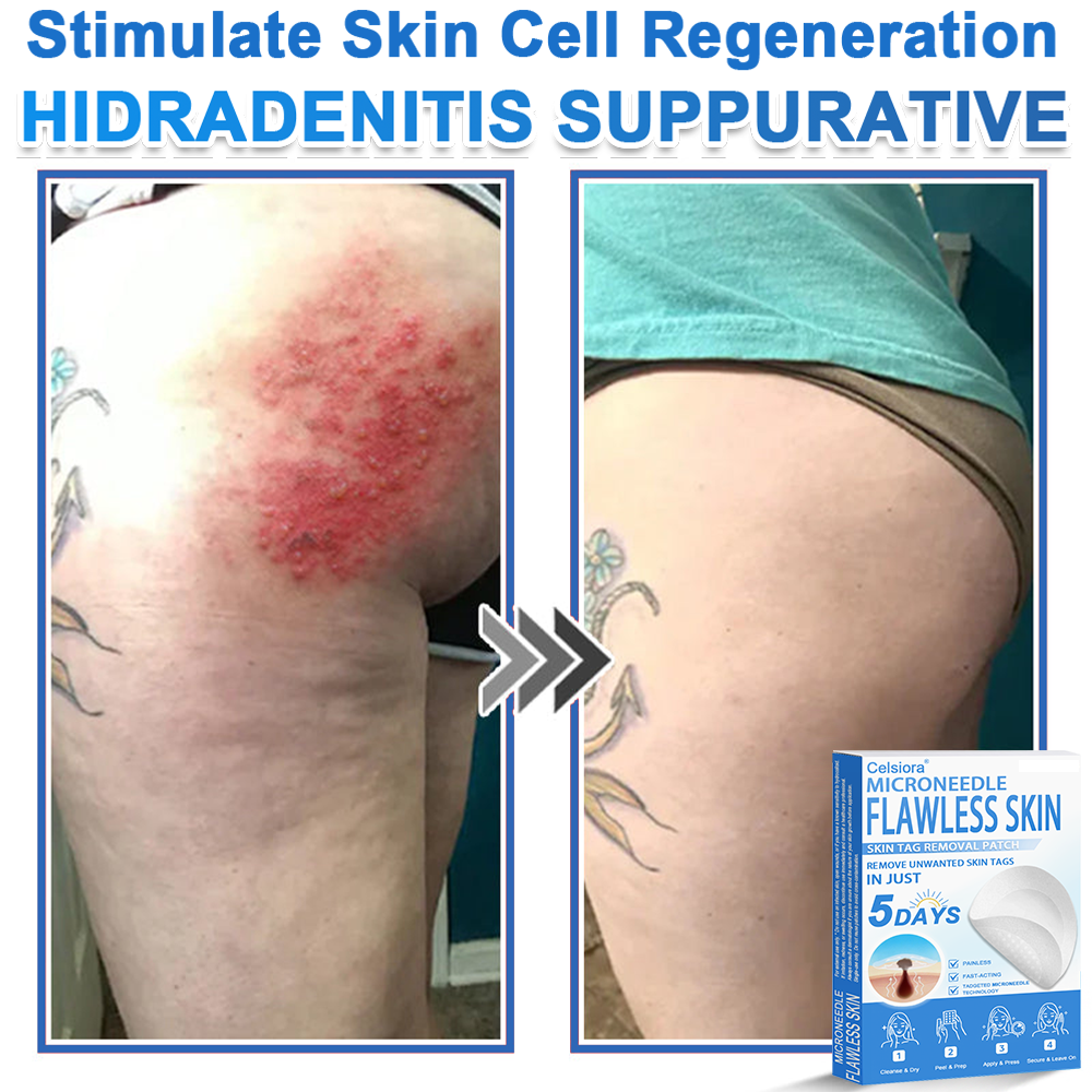 📌Celsiora® 2-in-1 Microneedle & Hydrocolloid Patch | Raised Moles,Acne,  Flat Warts & Skin Tags Remover | Improves Wrinkles, Scars & Blemishes | Invisible Pimple Patches for Face & Body
