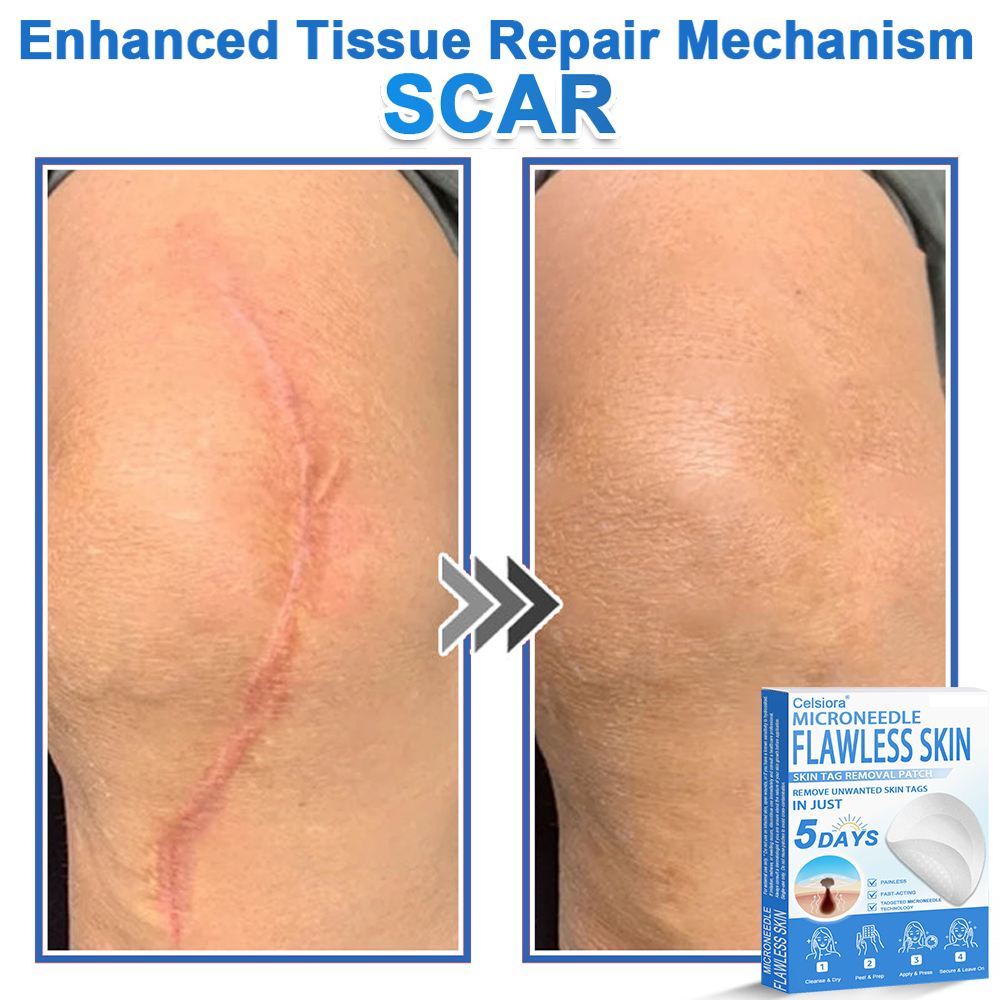 📌Celsiora® 2-in-1 Microneedle & Hydrocolloid Patch | Raised Moles,Acne,  Flat Warts & Skin Tags Remover | Improves Wrinkles, Scars & Blemishes | Invisible Pimple Patches for Face & Body