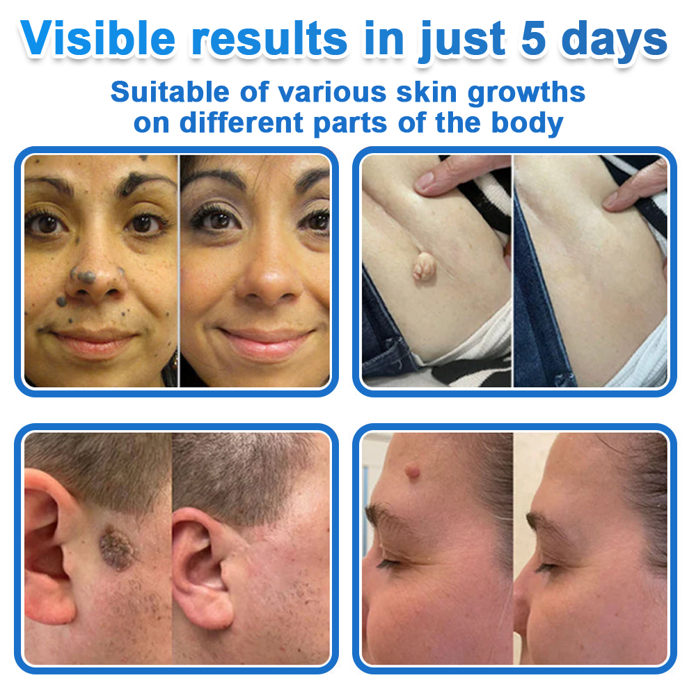 📌Celsiora® 2-in-1 Microneedle & Hydrocolloid Patch | Raised Moles,Acne,  Flat Warts & Skin Tags Remover | Improves Wrinkles, Scars & Blemishes | Invisible Pimple Patches for Face & Body