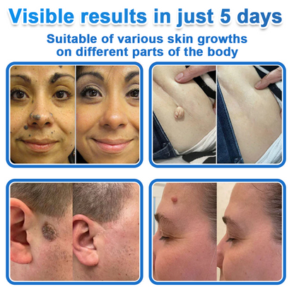 📌Celsiora® 2-in-1 Microneedle & Hydrocolloid Patch | Raised Moles,Acne,  Flat Warts & Skin Tags Remover | Improves Wrinkles, Scars & Blemishes | Invisible Pimple Patches for Face & Body