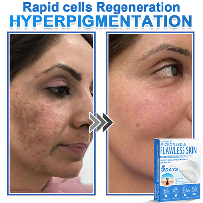 📌Celsiora® 2-in-1 Microneedle & Hydrocolloid Patch | Raised Moles,Acne,  Flat Warts & Skin Tags Remover | Improves Wrinkles, Scars & Blemishes | Invisible Pimple Patches for Face & Body